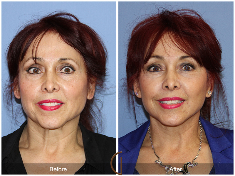 Female Facelift  Before & After Image