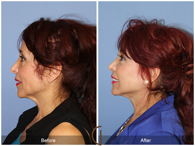 Female Facelift  Before & After Image