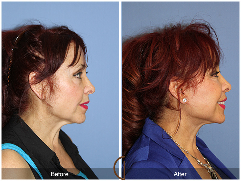 Female Facelift  Before & After Image