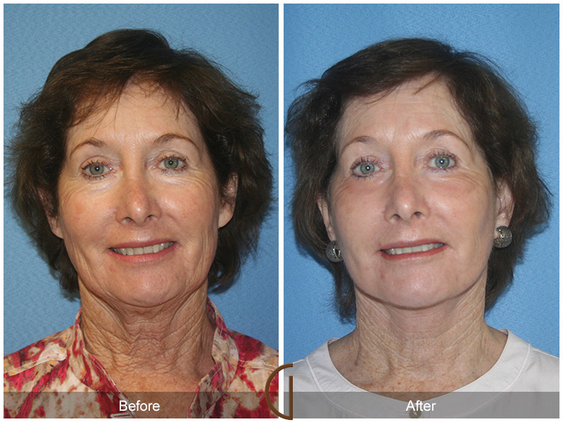 Female Facelift  Before & After Image