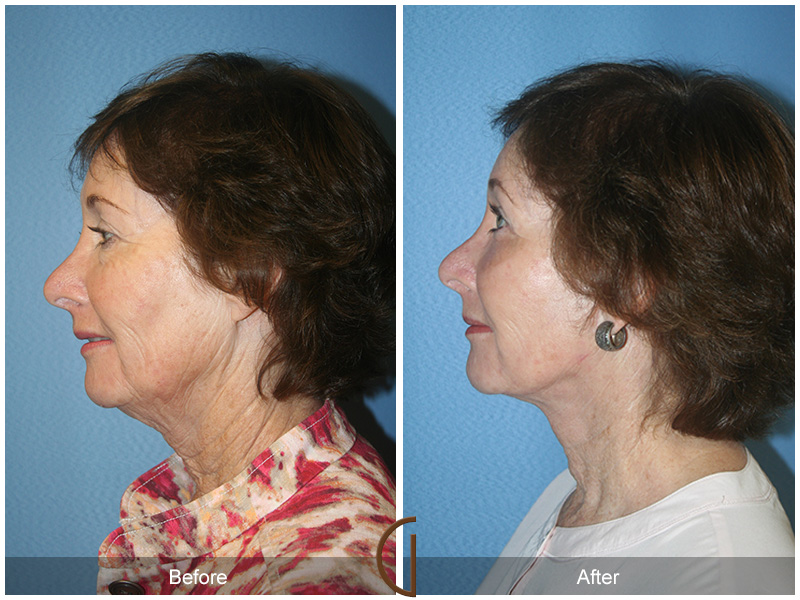 Female Facelift  Before & After Image