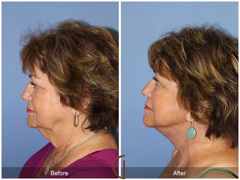 Female Facelift  Before & After Image