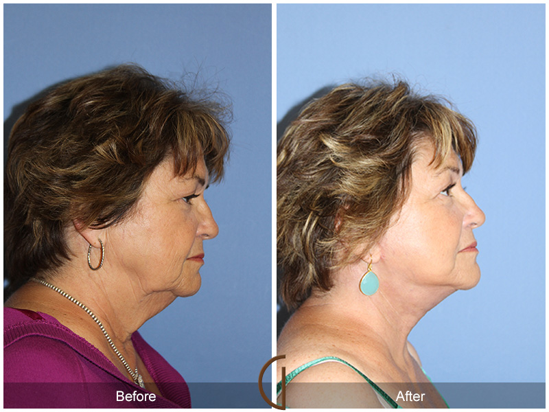 Female Facelift  Before & After Image