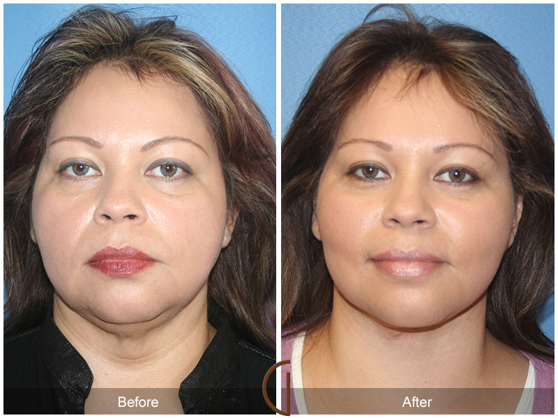 Female Facelift  Before & After Image