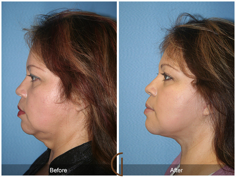 Female Facelift  Before & After Image