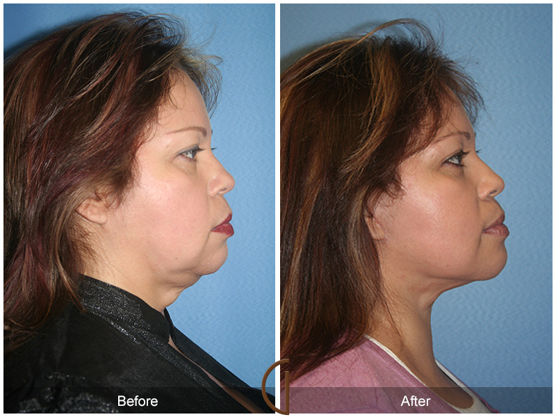 Female Facelift  Before & After Image