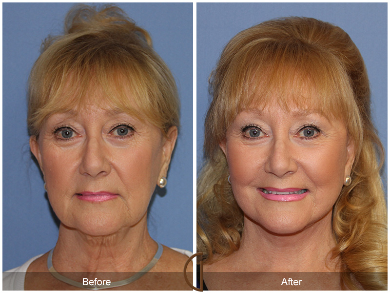 Female Facelift  Before & After Image