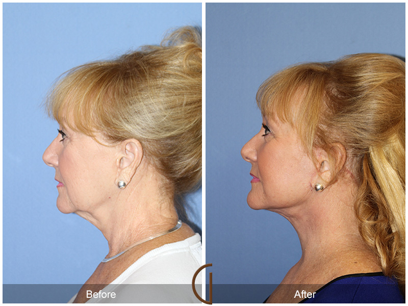 Female Facelift  Before & After Image