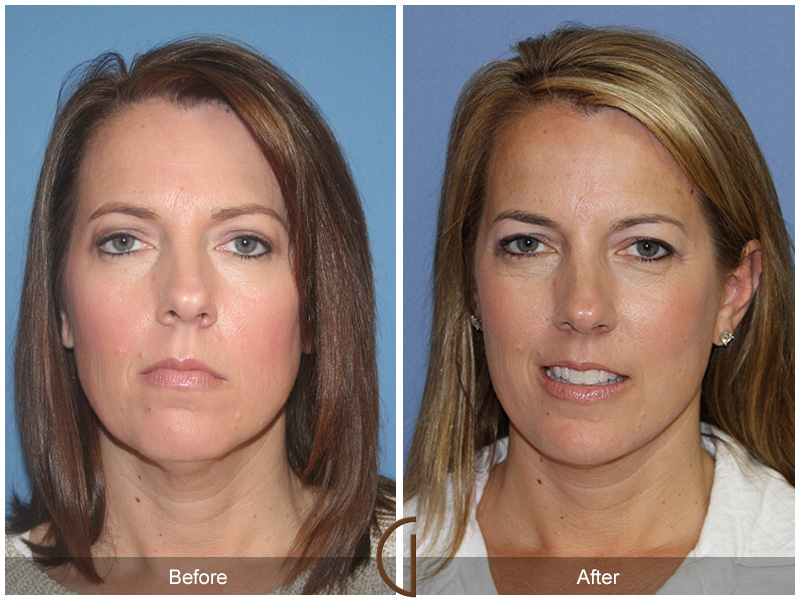 Female Facelift  Before & After Image