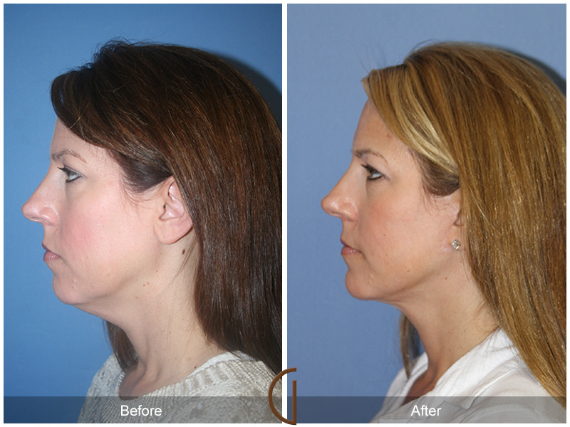 Female Facelift  Before & After Image