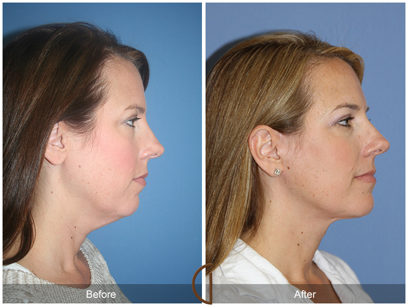 Female Facelift  Before & After Image