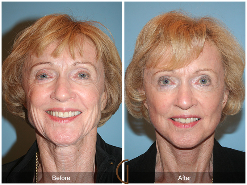 Female Facelift  Before & After Image