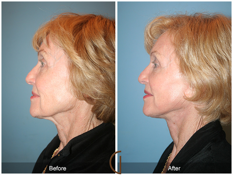 Female Facelift  Before & After Image