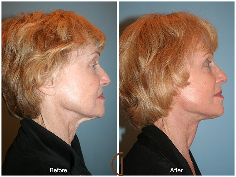 Female Facelift  Before & After Image