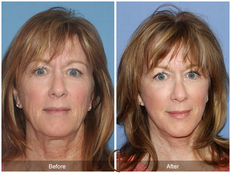 Female Facelift  Before & After Image