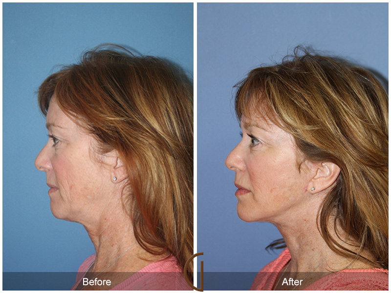 Female Facelift  Before & After Image