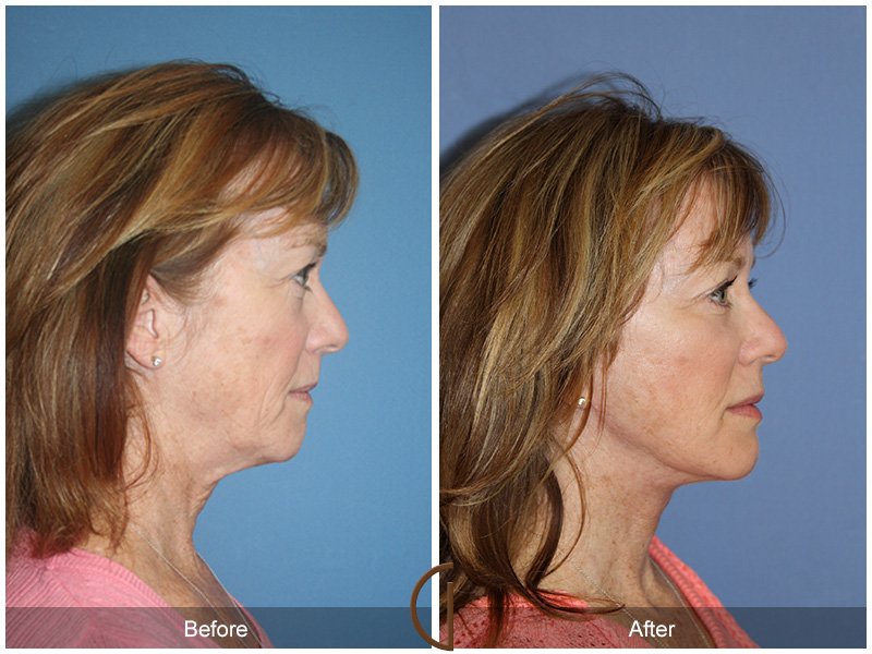 Female Facelift  Before & After Image