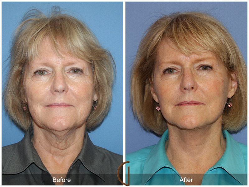 Female Facelift  Before & After Image