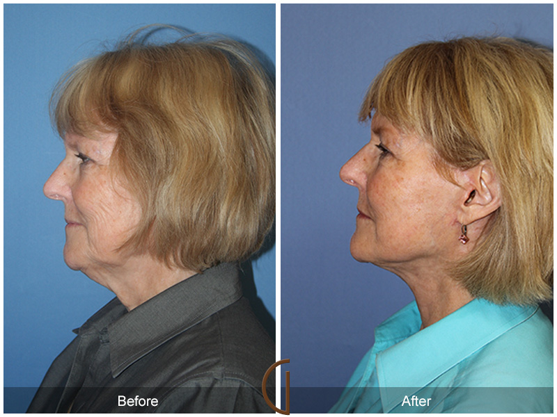 Female Facelift  Before & After Image