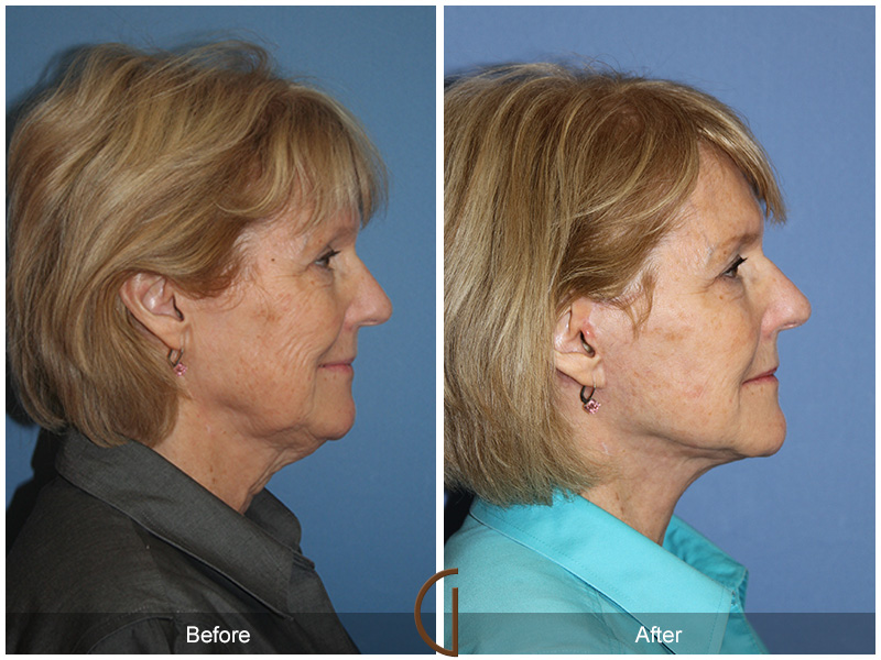 Female Facelift  Before & After Image