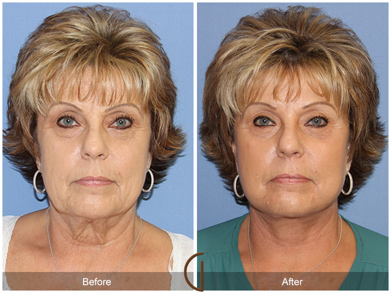 Female Facelift  Before & After Image