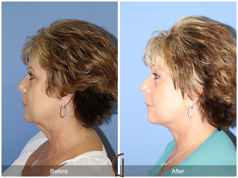 Female Facelift  Before & After Image