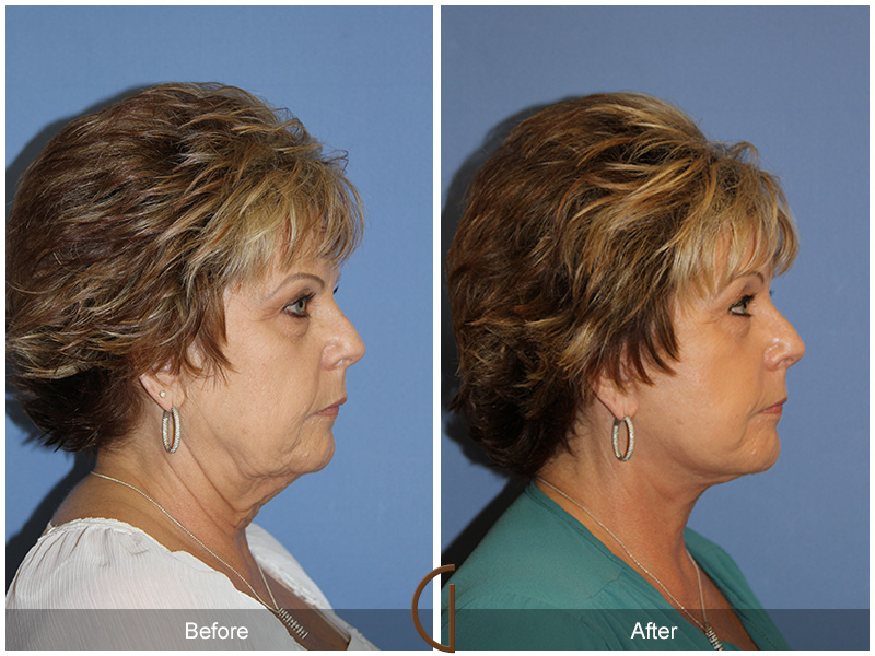 Female Facelift  Before & After Image