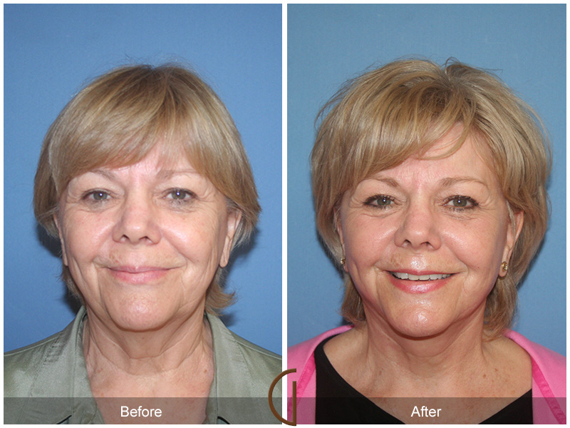 Female Facelift  Before & After Image