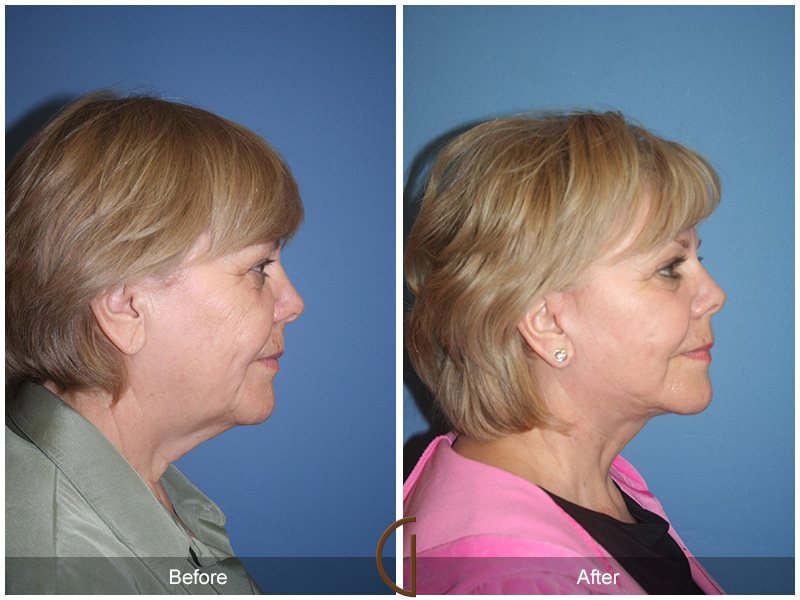 Female Facelift  Before & After Image