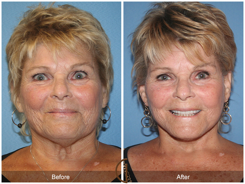 Female Facelift  Before & After Image