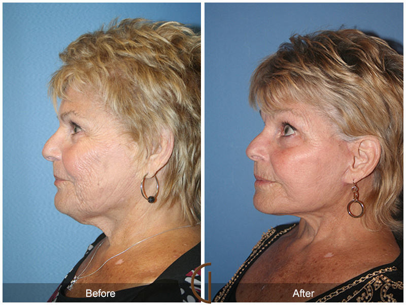 Female Facelift  Before & After Image