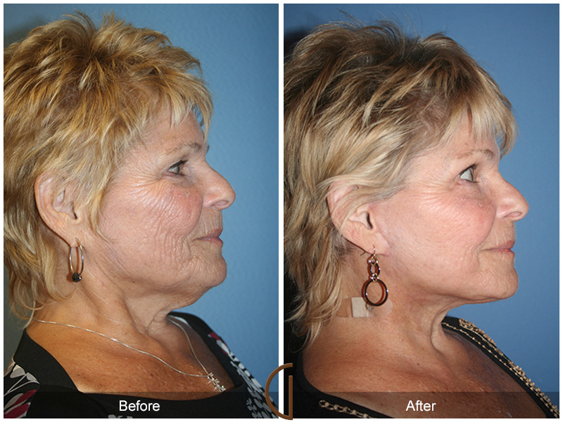 Female Facelift  Before & After Image