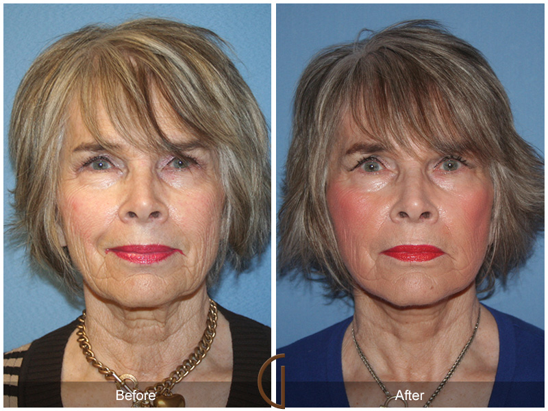 Female Facelift  Before & After Image