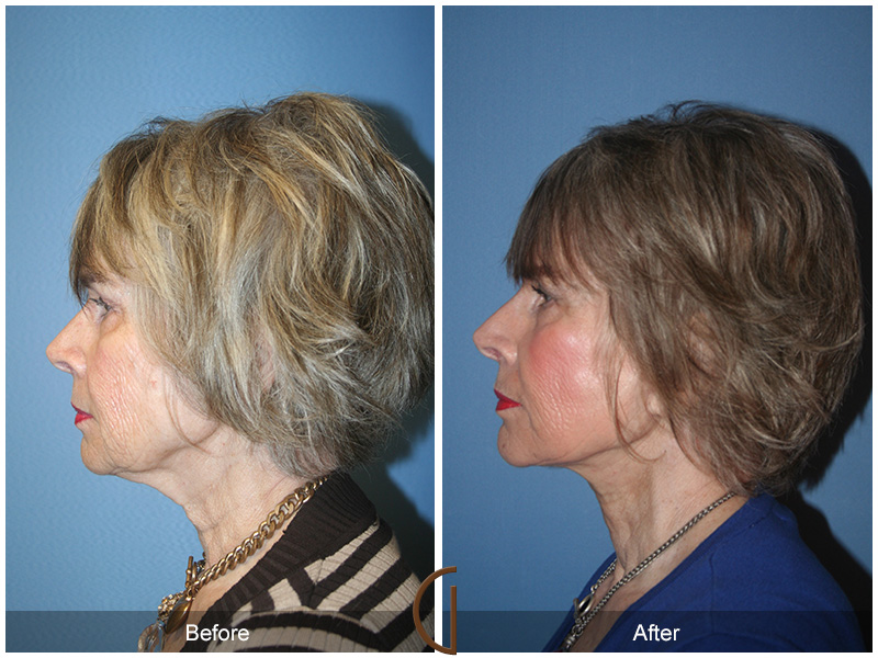 Female Facelift  Before & After Image