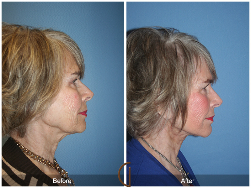 Female Facelift  Before & After Image