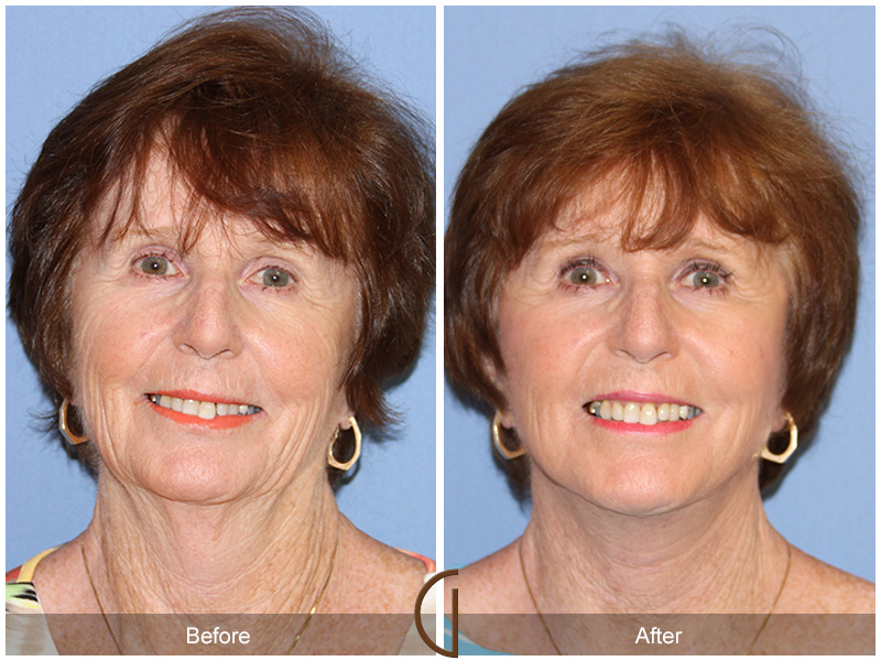 Female Facelift  Before & After Image