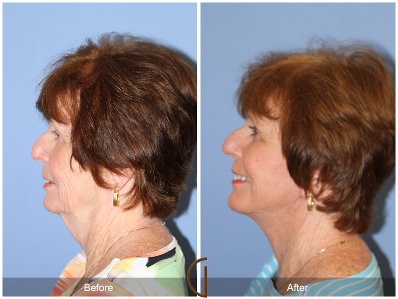 Female Facelift  Before & After Image