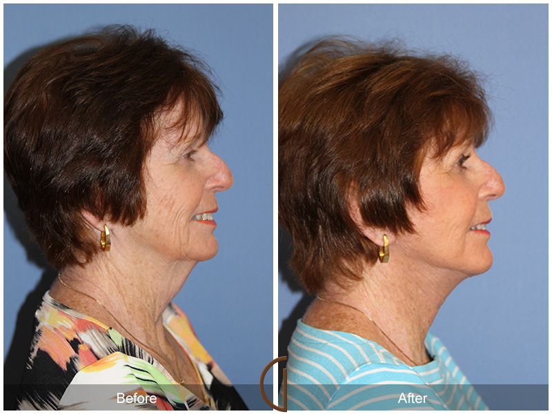 Female Facelift  Before & After Image