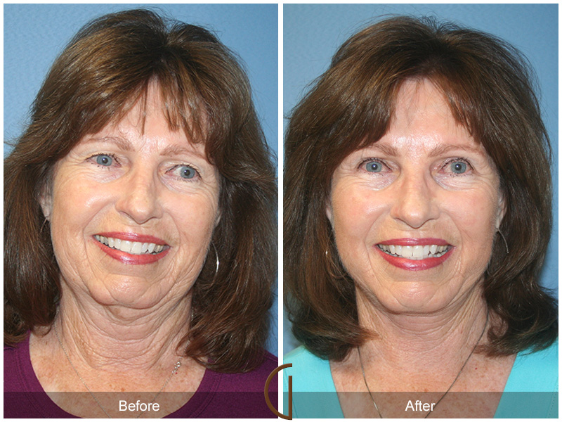 Female Facelift  Before & After Image