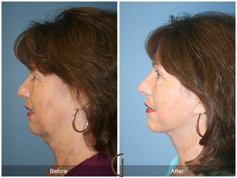 Female Facelift  Before & After Image