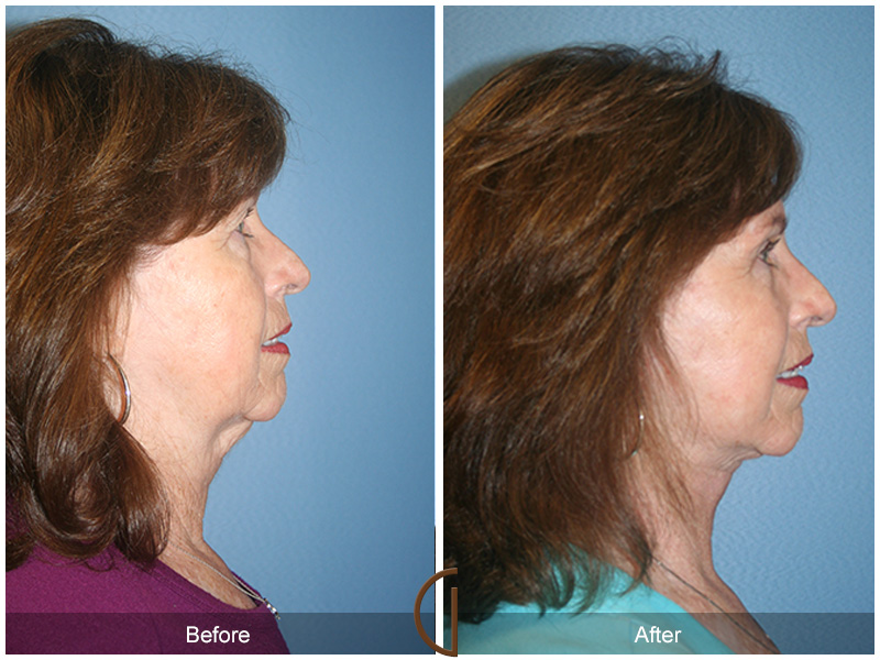 Female Facelift  Before & After Image