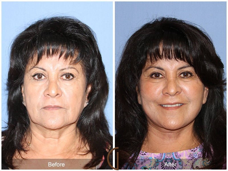 Female Facelift  Before & After Image