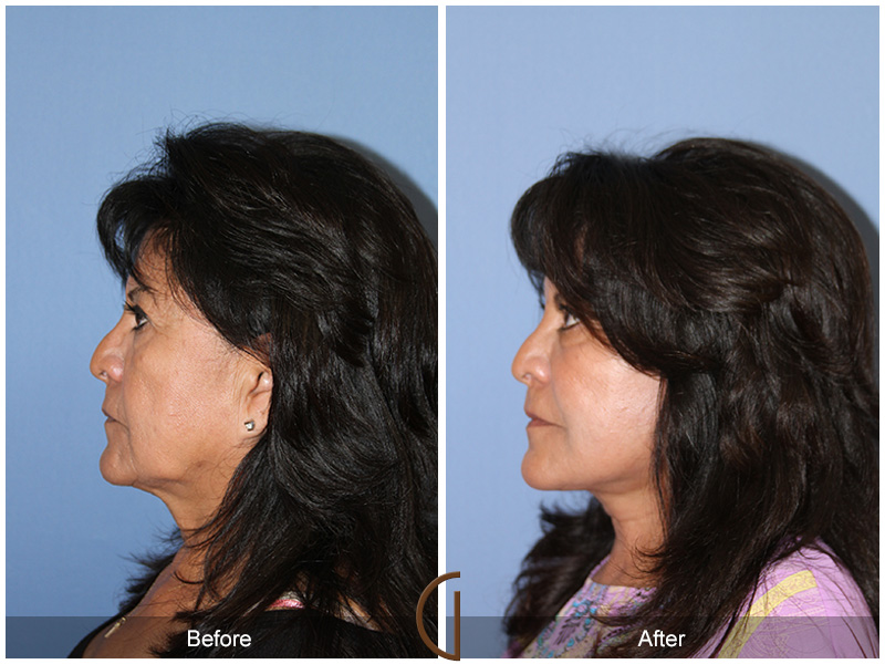 Female Facelift  Before & After Image