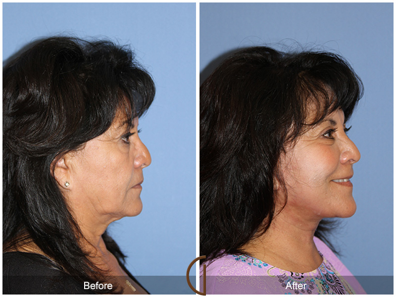 Female Facelift  Before & After Image