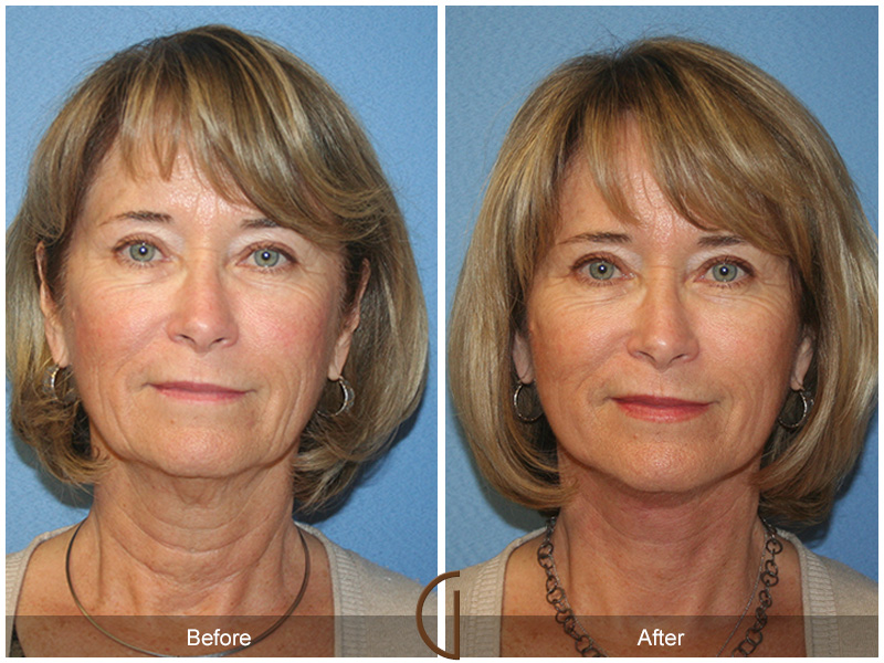 Female Facelift  Before & After Image