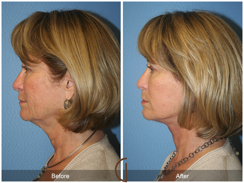 Female Facelift  Before & After Image