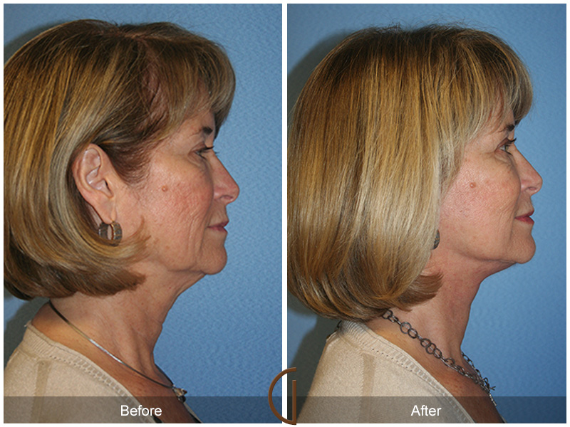 Female Facelift  Before & After Image