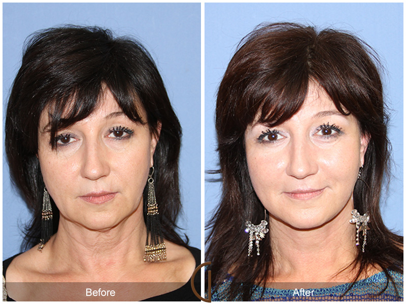 Female Facelift  Before & After Image