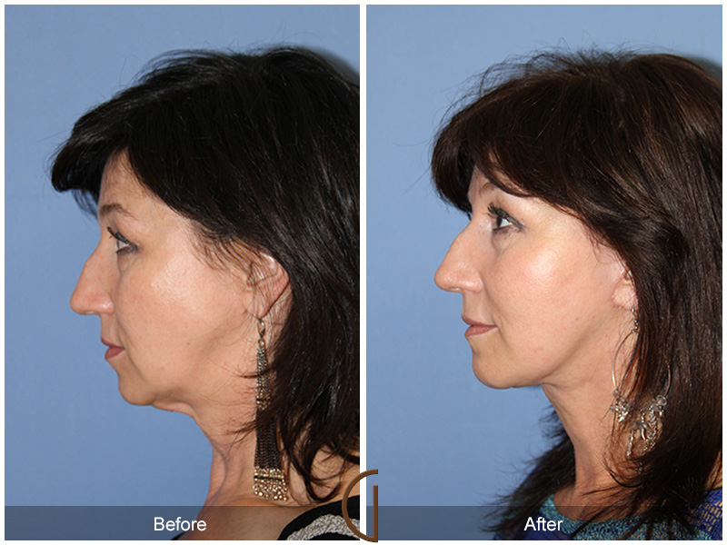 Female Facelift  Before & After Image