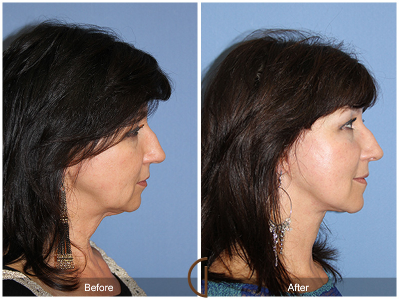 Female Facelift  Before & After Image